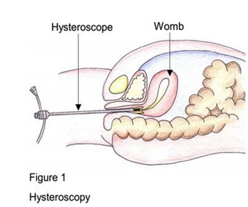 Vaginal epidermal cyst – Hysteroscopy Newsletter