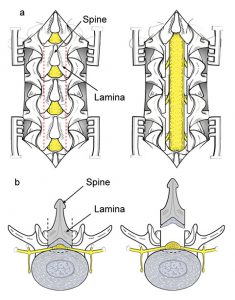 discectomy and laminectomy